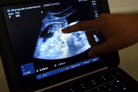 Slovakya’da kürtaj olmak isteyen kadınlar ultrason görüntülerini izlemeye zorlanacak